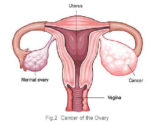 Ovarian Cancer Cure Via Gene Therapy