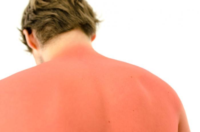 How to treat sunburn this summer?